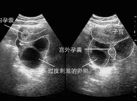 泰国试管哪个医院好排名高？试管安全／高效才是重点