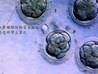 上海第三代试管技术，优缺点分析及三点对比